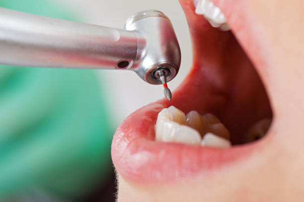 Best Emergency Wisdom Teeth Removal in Holdrege, NE